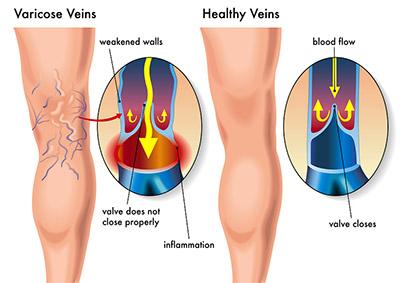 Take this quiz to find the ideal vein treatment that meets your unique needs, ensuring a swift recovery and lasting results.