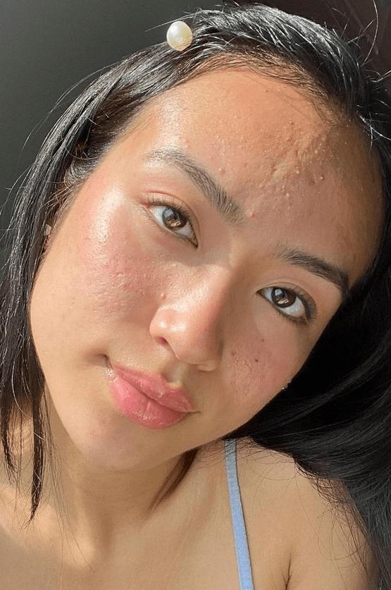 Are you navigating the vast world of Korean skincare and feeling overwhelmed by choices? Take this quiz to unveil the best products tailored just for your acne-prone skin!