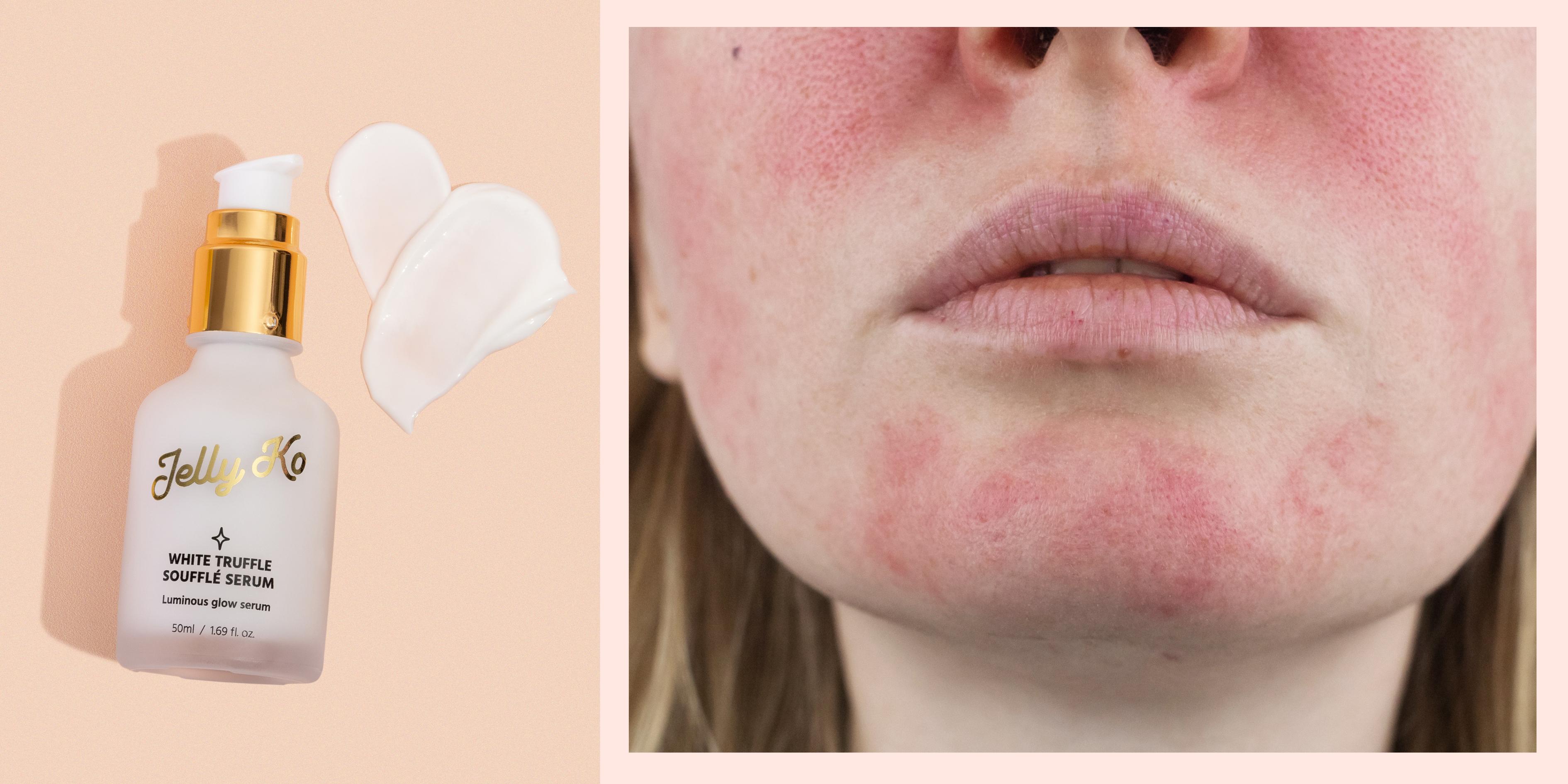 Struggling with rosacea? Discover which K-Beauty product suits your skin best with this fun quiz!