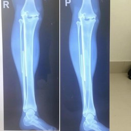 Medical Report for Leg Fracture

**Hospital Name:** National Medical College Hospital  
**Address:** Birgunj  

**Patient Details:**  
**Name:** Prabesh Kumar Sah  
**Age:** 18  
**Sex:** Male  

**Date of Examination:** [Insert Date]  

**Chief Complaint:** The patient presents with pain and swelling in the left leg following an injury sustained during a sports activity
