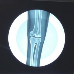 Medical Report for Leg Fracture

**Hospital Name:** National Medical College Hospital  
**Address:** Birgunj  

**Patient Details:**  
**Name:** Prabesh Kumar Sah  
**Age:** 18  
**Sex:** Male  

**Date of Examination:** [Insert Date]  

**Chief Complaint:** The patient presents with pain and swelling in the left leg following an injury sustained during a sports activity