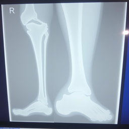 Medical Report for Leg Fracture

**Hospital Name:** National Medical College Hospital  
**Address:** Birgunj  

**Patient Details:**  
**Name:** Prabesh Kumar Sah  
**Age:** 18  
**Sex:** Male  

**Date of Examination:** [Insert Date]  

**Chief Complaint:** The patient presents with pain and swelling in the left leg following an injury sustained during a sports activity