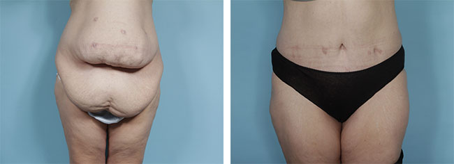 Everything You Need to Know About Body Contouring in Bromley