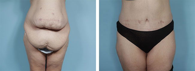 Here’s everything you need to know about body contouring, the different types of treatments available, and who can benefit from them.